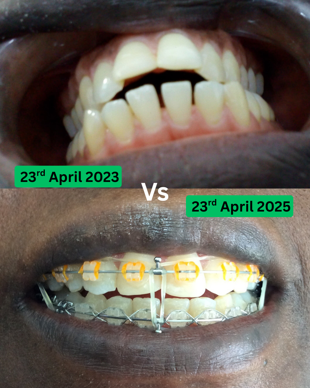 Braces transformation 8